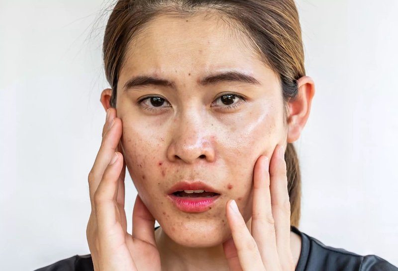 da dầu mụn nhạy cảm da dau mun nhay cam